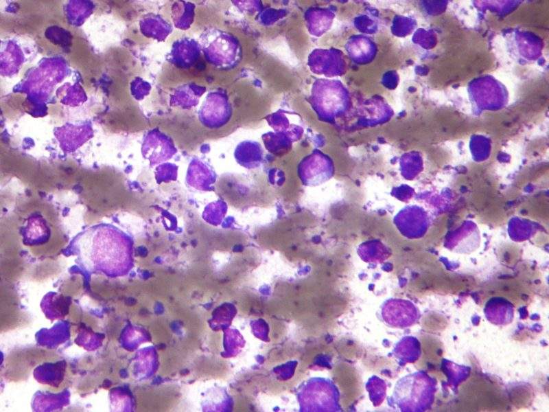 1198px-Large_b_cell_lymphoma_-_cytology_small