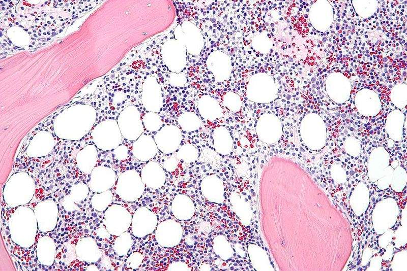 hairy cell leukaemia