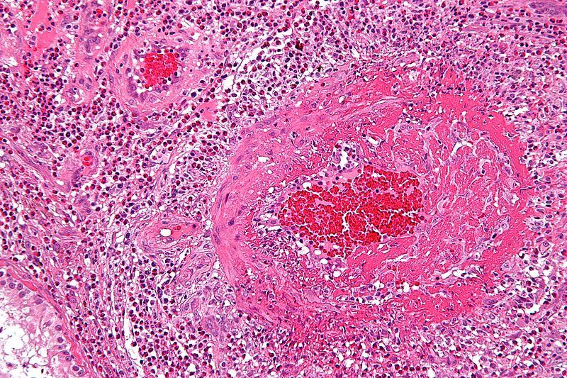 micrograph of eosinophilic vasculitis consistent with Churg-Strauss syndrome