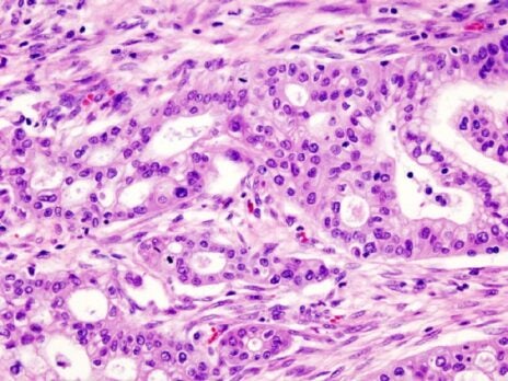 Pancreatic cancer: treatment options remain limited after Imbruvica's failed trial
