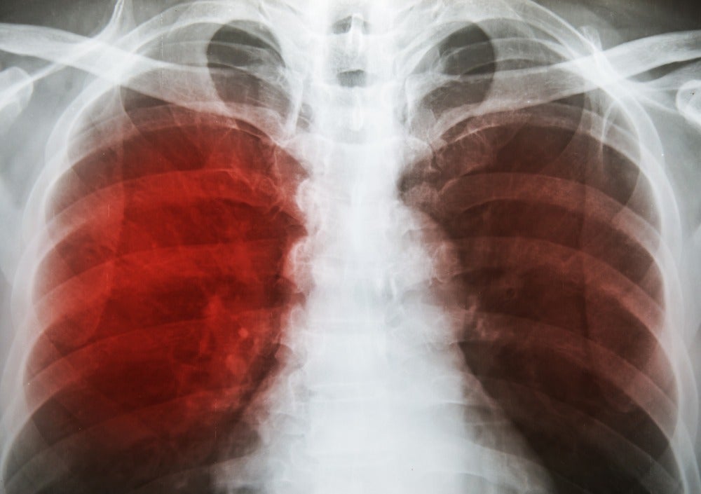 Tuberculosis in Europe