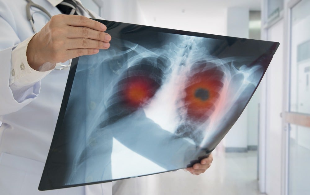 Future of lung cancer testing