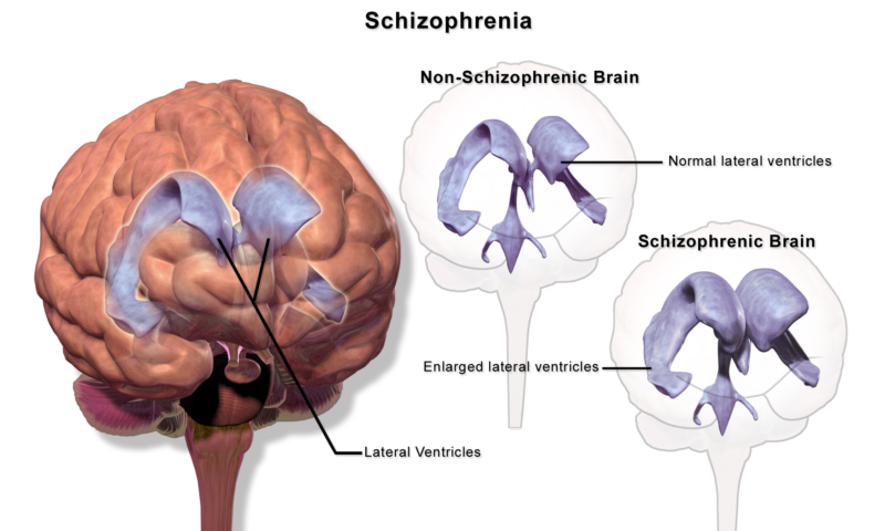 Schizophrenia treatment