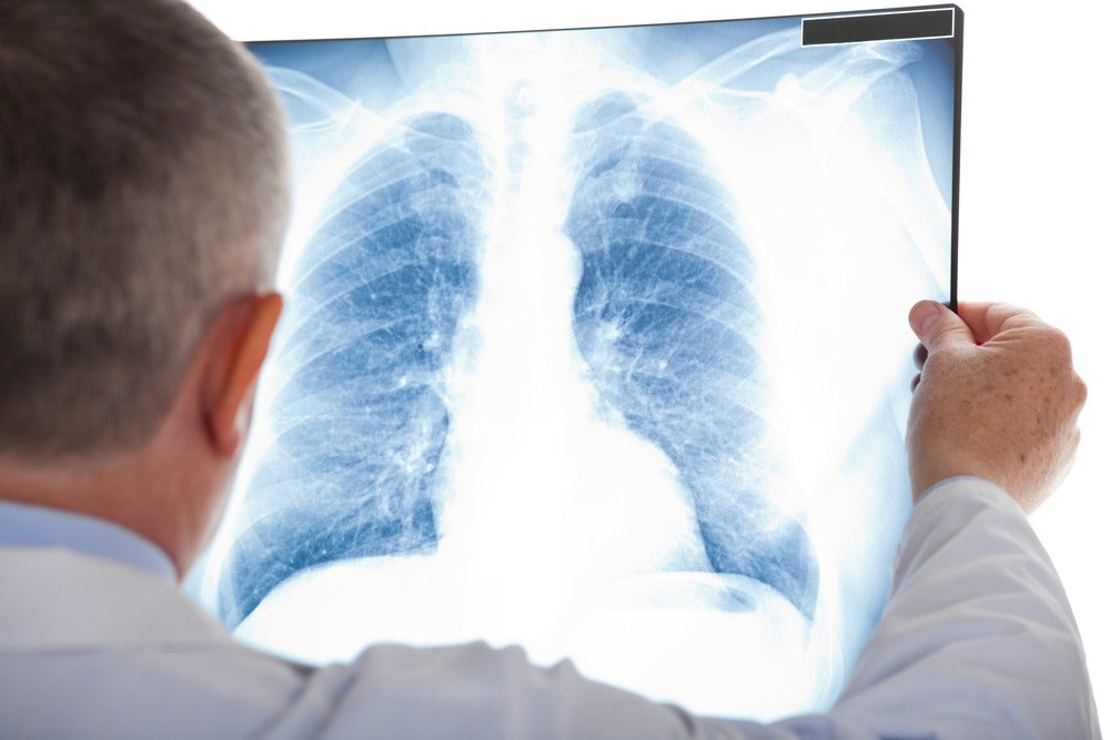 Idiopathic pulmonary fibrosis treatment