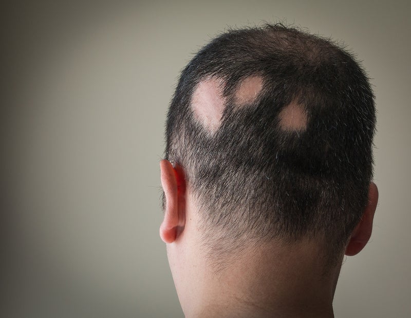 Alopecia areata treatment: a role involving Janus Kinase (JAK) inhibitors