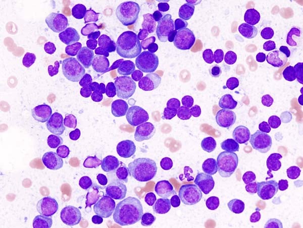GSK refractory multiple myeloma
