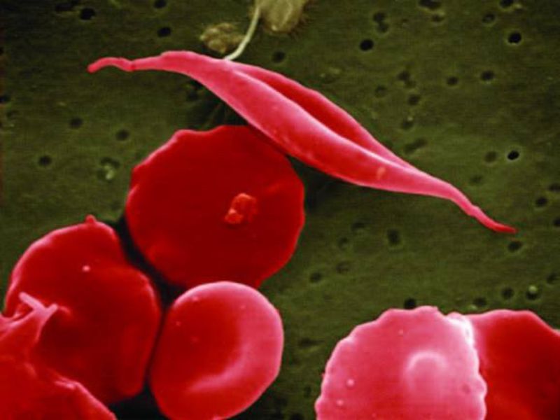 NIH and Gates Foundation fund sickle cell disease and HIV research
