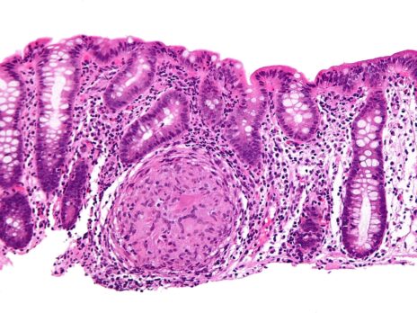 Takeda’s SC Entyvio meets primary endpoint in Crohn’s Disease