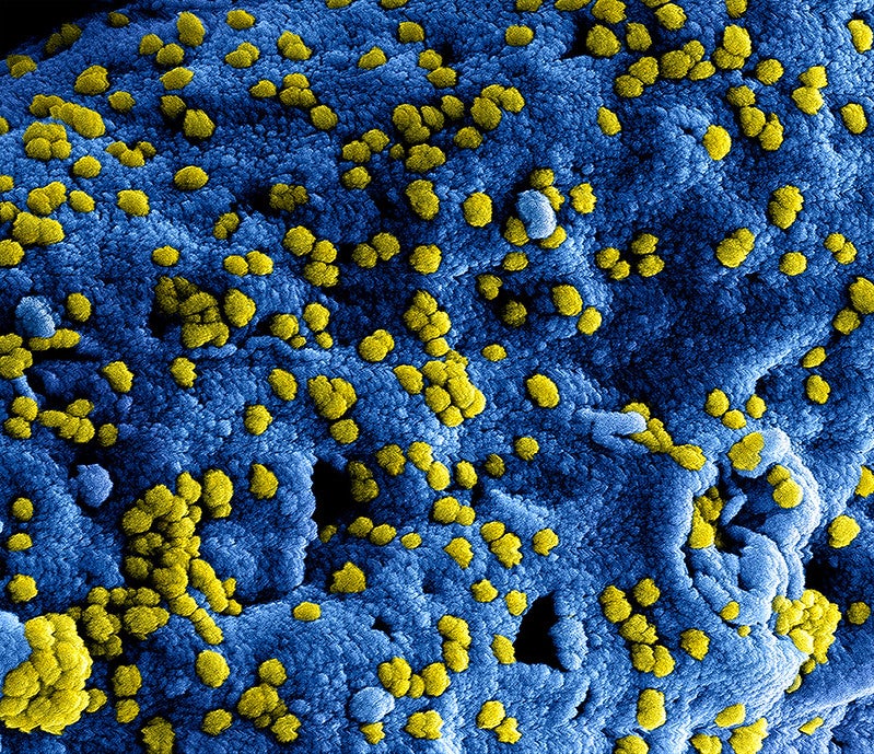 Covid-19: Colourised scanning electron micrograph of Middle East Respiratory Syndrome virus particles. Credit: NIAID.