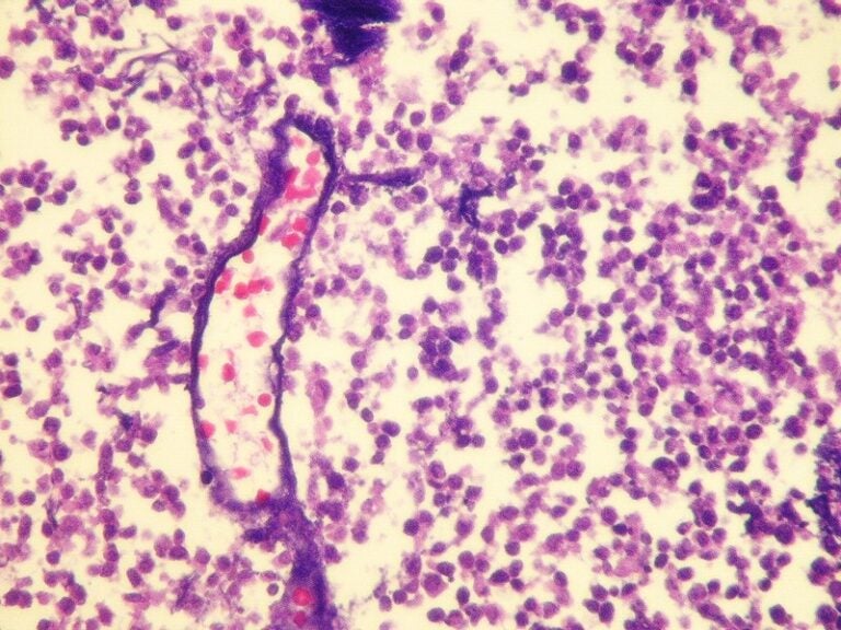 Imfinzi s Success In ES SCLC Not Matched In Combo With Tremelimumab 