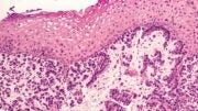 BeiGene’s Phase III tislelizumab for esophageal squamous cell carcinoma