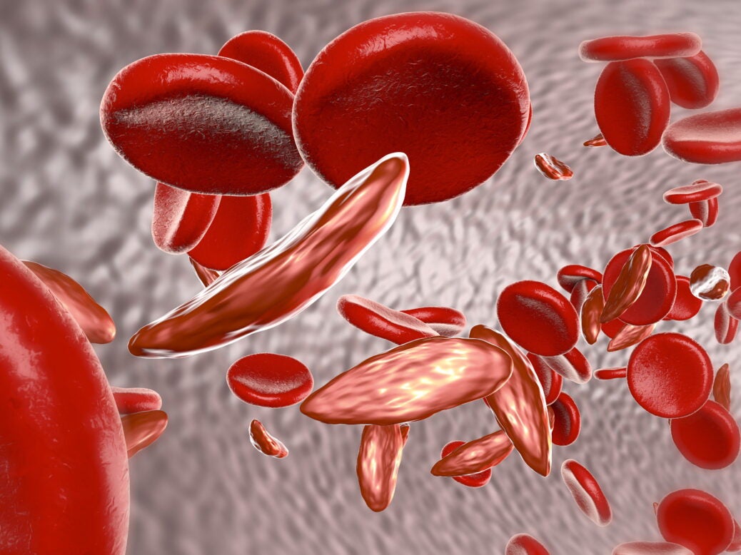 Gene therapy for sickle cell disease