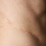 Surgery without scars