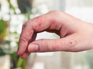 Chronic Hand Eczema