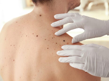 Africa has seen the largest growth in dermatology related trials over the past decade