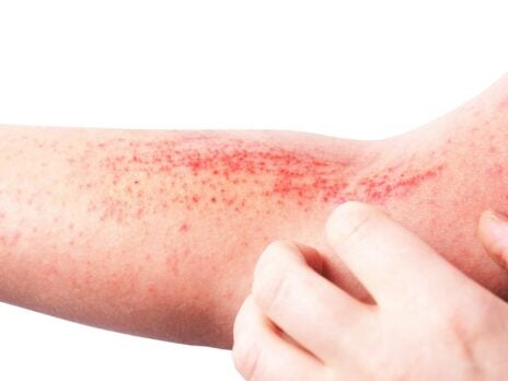 Impending regulatory approvals in atopic dermatitis (AD)