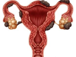 endometriosis; market