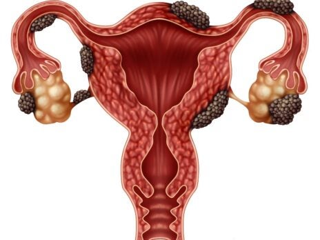 Endometriosis: how the market has developed and where it needs to be