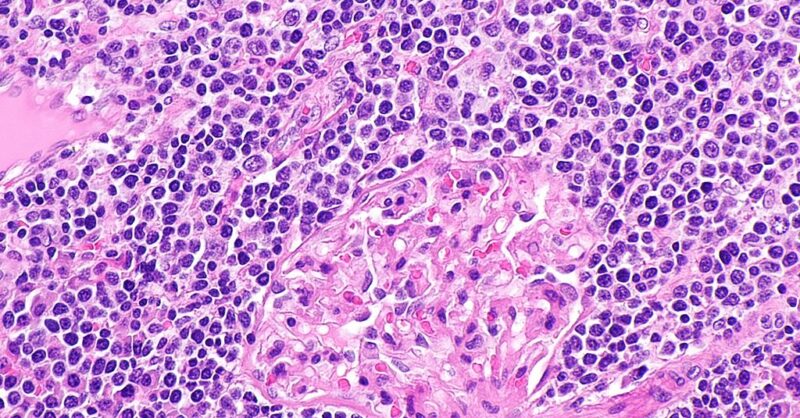 Health Canada approves BeiGene's Brukinsa for marginal zone lymphoma - Vimarsana News
