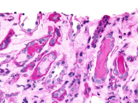 China’s NMPA accepts Innovent and IASO Bio’s multiple myeloma therapy NDA
