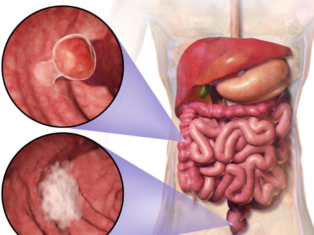 Evgen Pharma and University of Michigan to study colorectal cancer asset