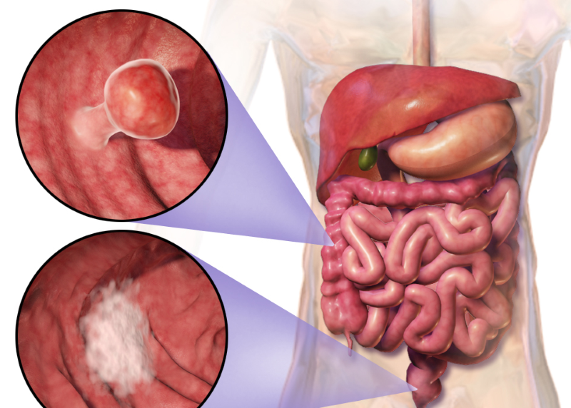 Evgen Pharma and University of Michigan to study colorectal cancer asset