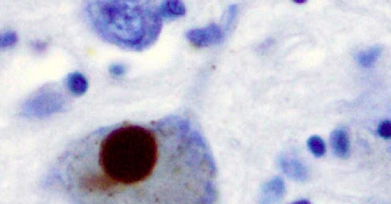 Biogen, Alectos collaborate to develop Parkinson's disease treatment - Vimarsana News