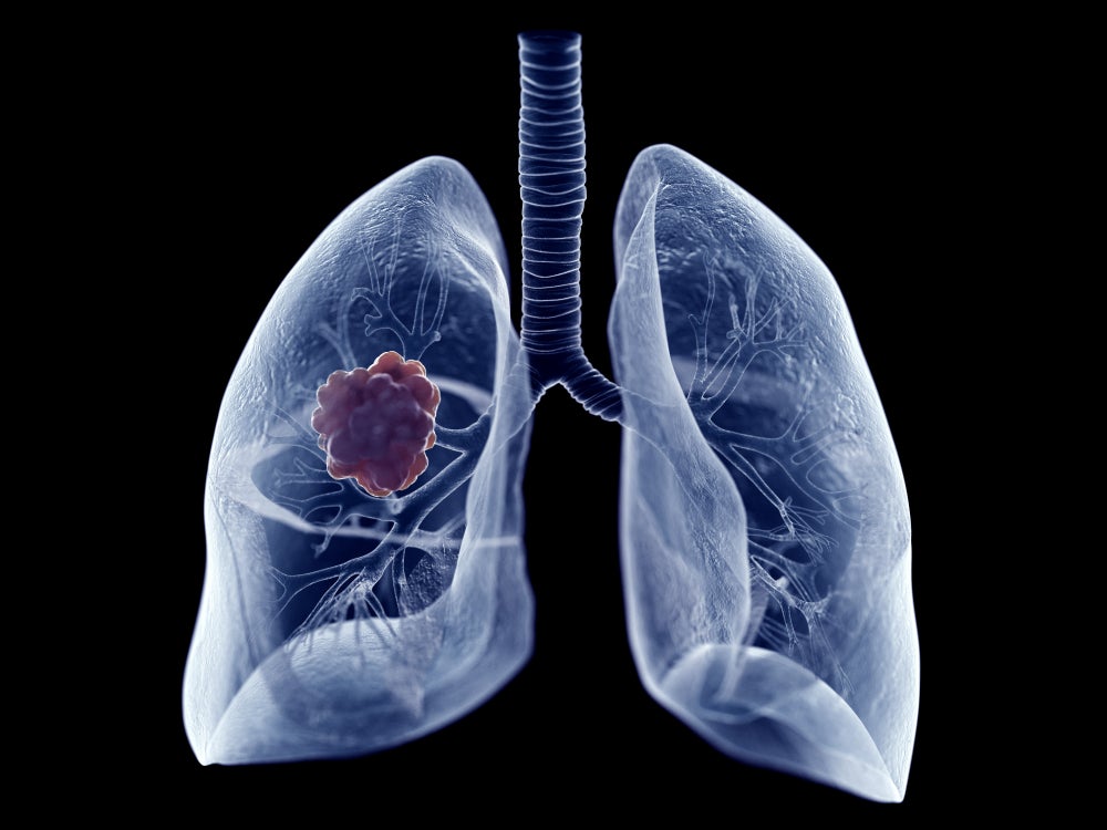3D rendering of a lung tumor