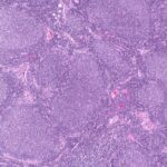 UK NICE recommends zanubrutinib for Waldenstrom’s macroglobulinaemia