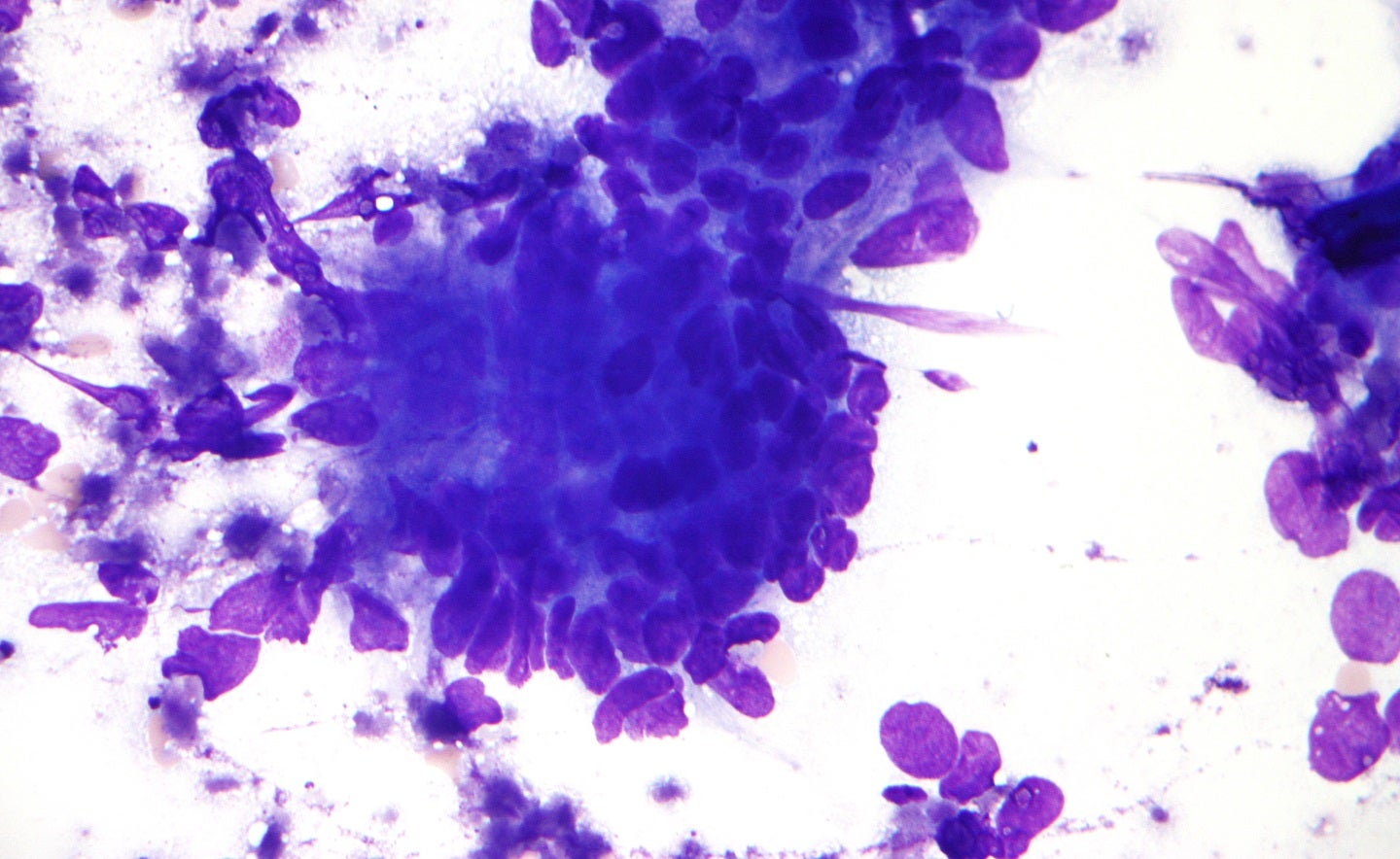 HUTCHMED concludes FDA rolling submission for colorectal cancer treatment