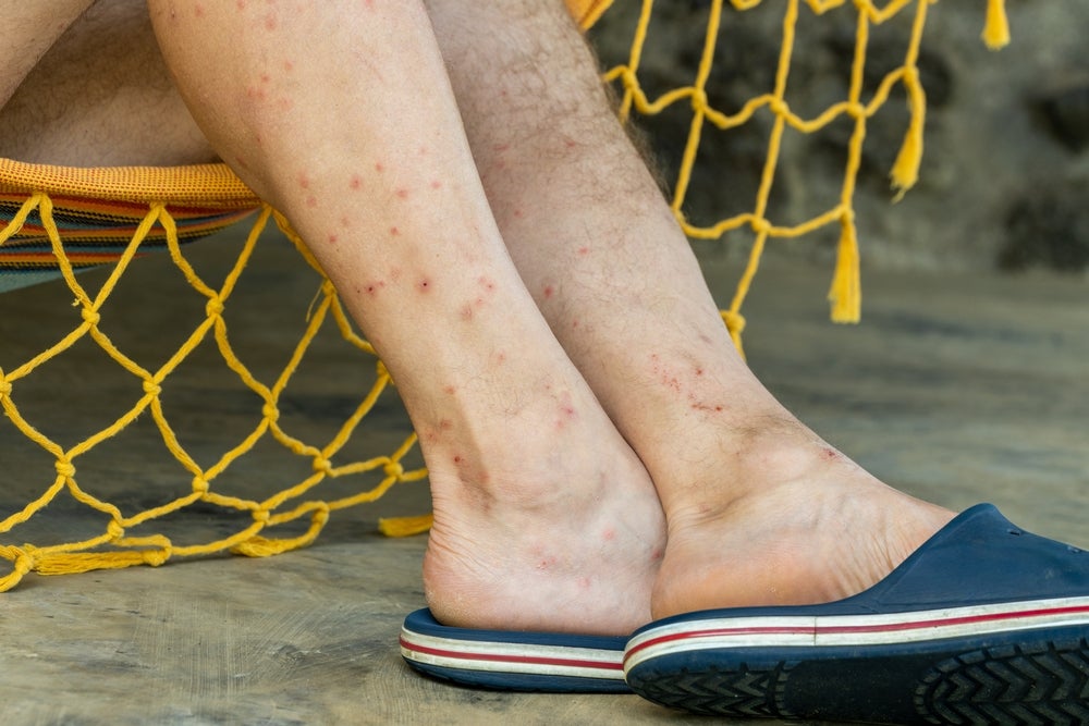 Gilead teams up with WHO again to eliminate parasitic tropical disease
