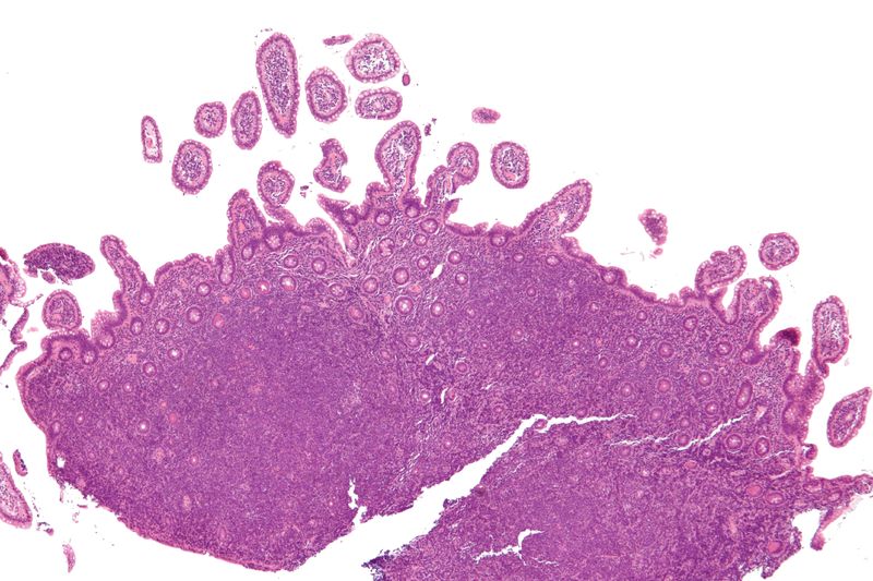 Mantle cell lymphoma - low mag