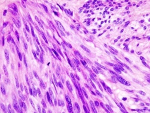 Image: A hematoxylin-eosin stain of a gastrointestinal stromal tumor of the stomach.