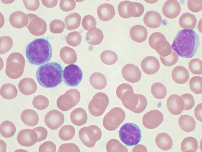 Chronic lymphocytic leukemia