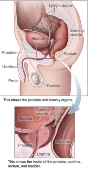 Prostate cancer 