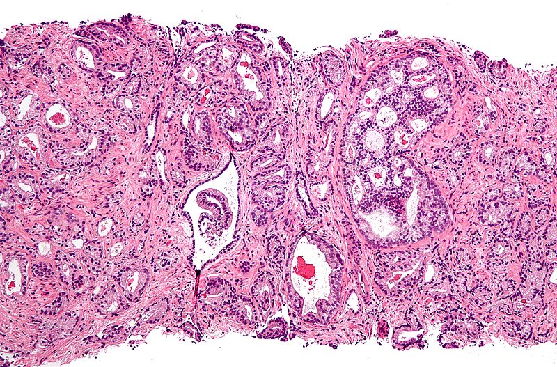 Prostate cancer with Gleason pattern 4 low mag